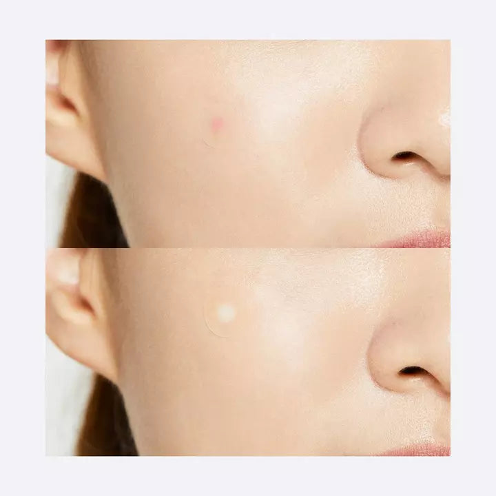 Acne Pimple Master Patch