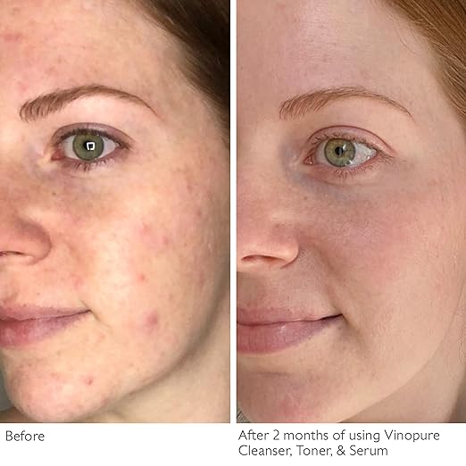 Natural Salicylic Acid Pore Minimizing Toner